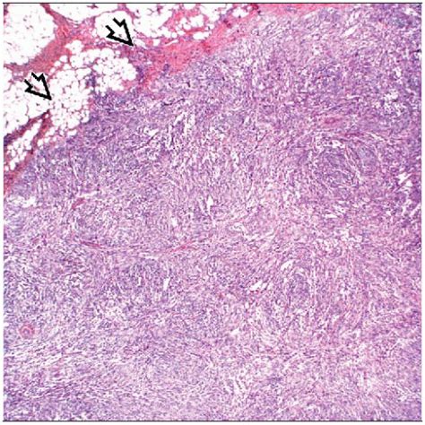 noduläre fasziitis|Nodular Fasciitis: Pathology, Causes & Treatment